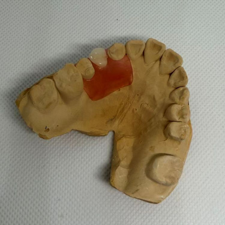 Dental Removable Partial Valplast Denture
