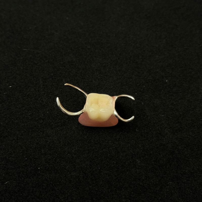 A metal framework partial denture with a single replacement tooth